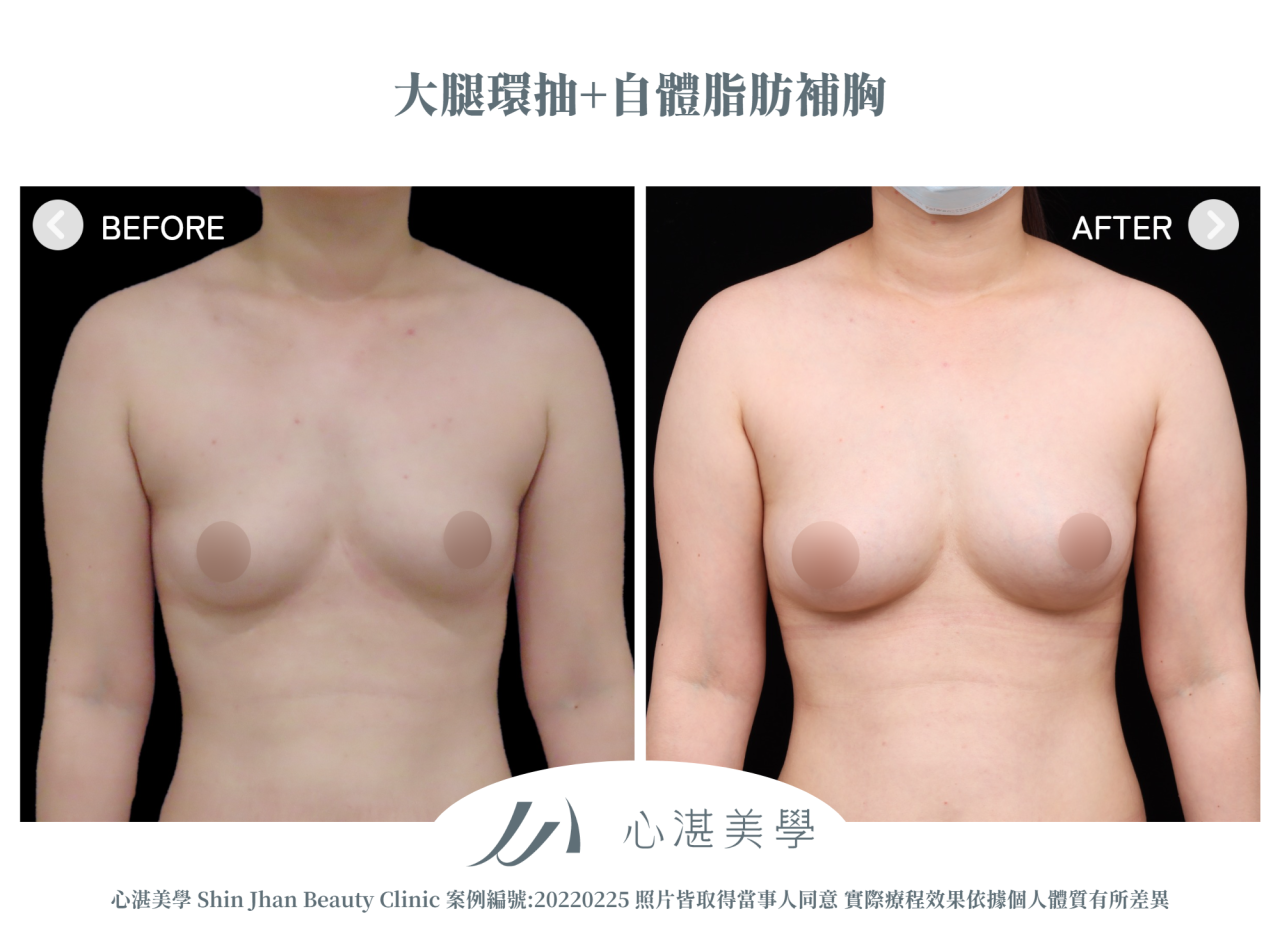 大腿環抽+自體脂肪補胸 術前術後案例分享