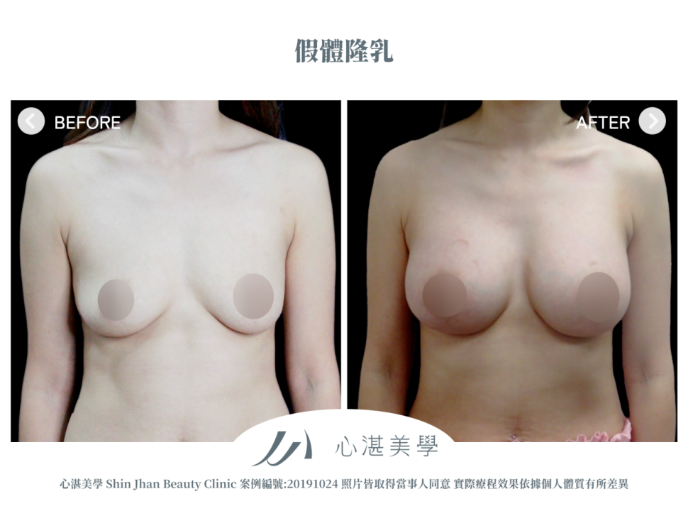 曼陀果凍矽膠隆乳 術前術後案例分享