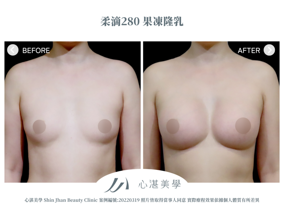 柔滴隆乳 術前術後案例分享