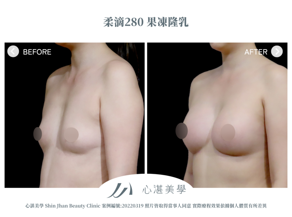 柔滴隆乳 術前術後案例分享