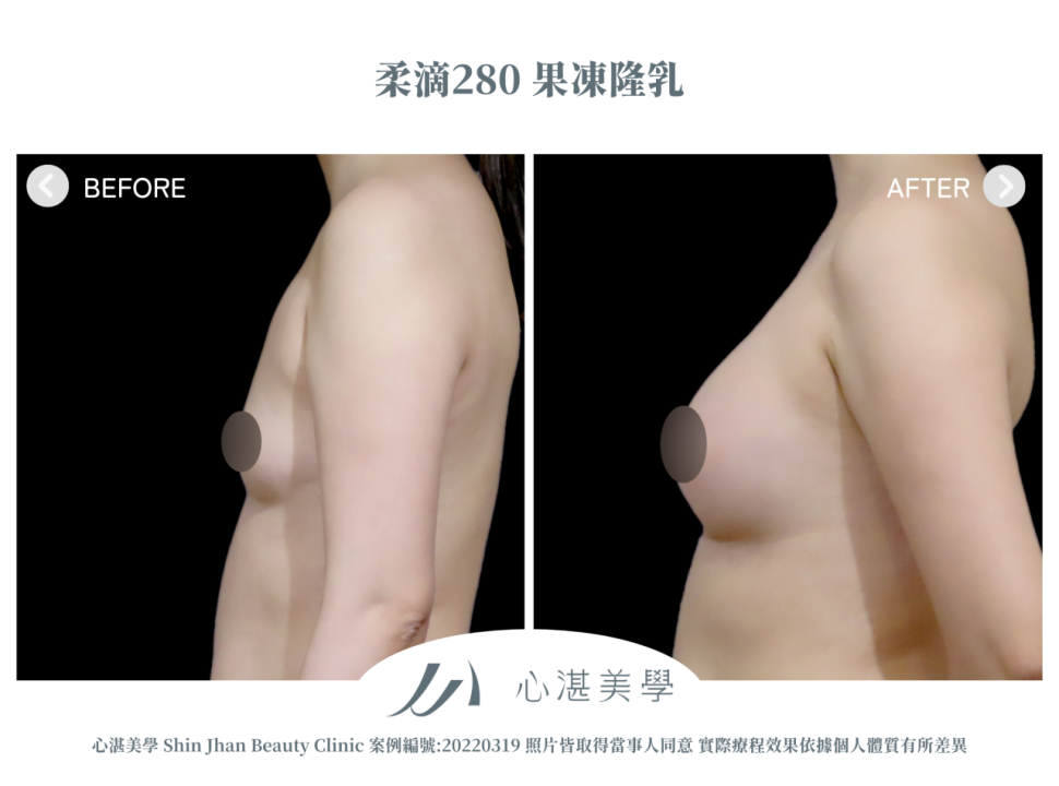 柔滴隆乳 術前術後案例分享