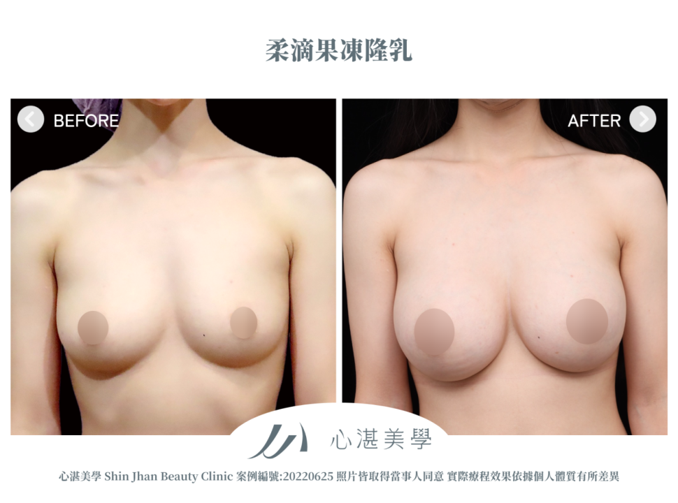 柔滴隆乳 術前術後案例分享