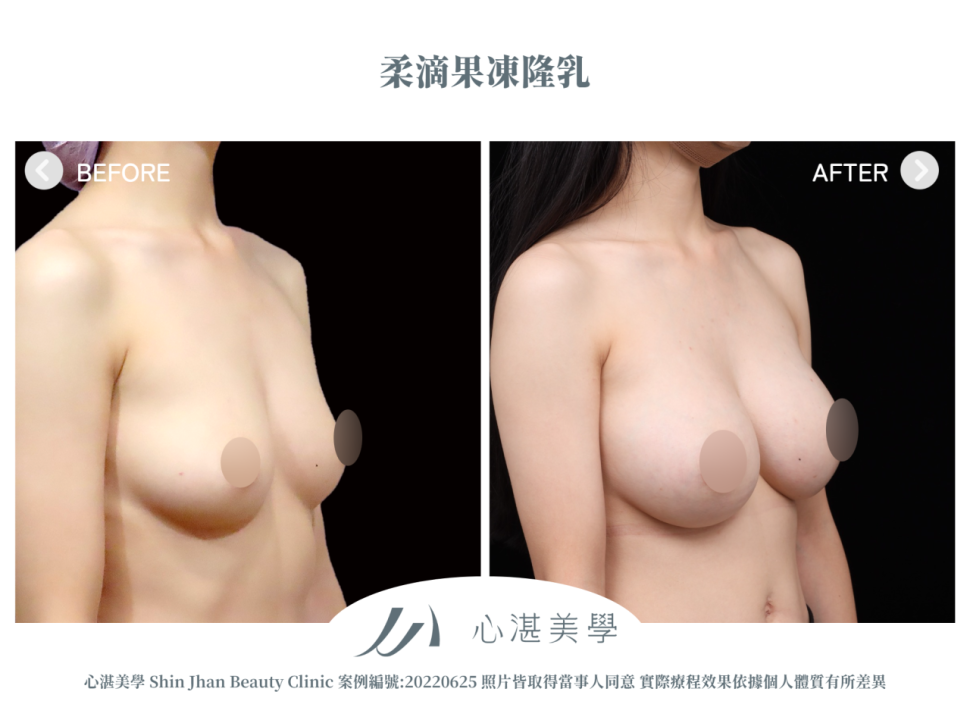 柔滴隆乳 術前術後案例分享