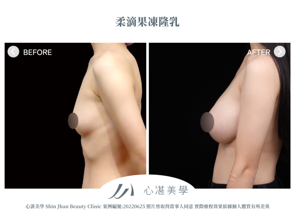 柔滴隆乳 術前術後案例分享