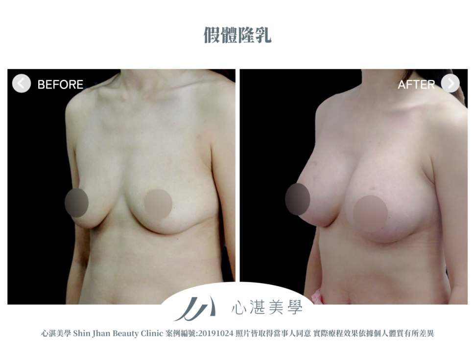 曼陀果凍矽膠隆乳 術前術後案例分享