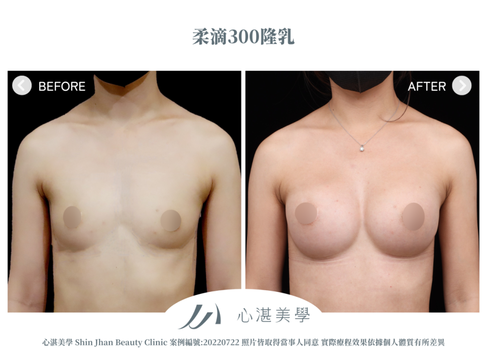 柔滴隆乳 術前術後案例分享