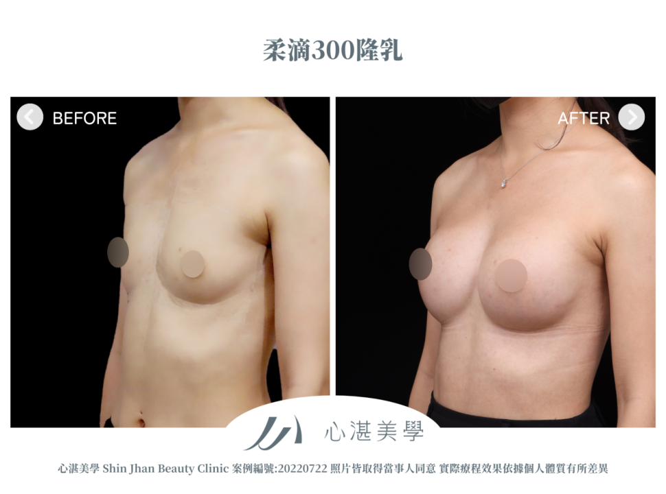 柔滴隆乳 術前術後案例分享