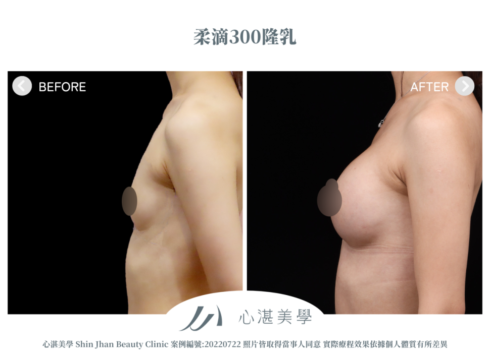 柔滴隆乳 術前術後案例分享
