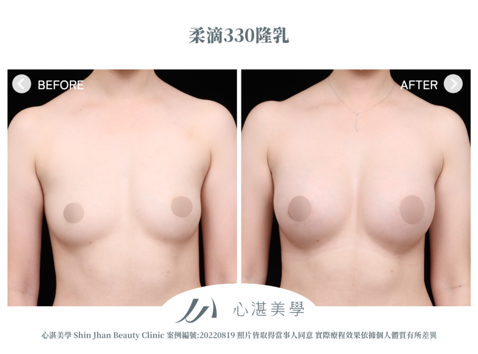 柔滴隆乳 術前術後案例分享