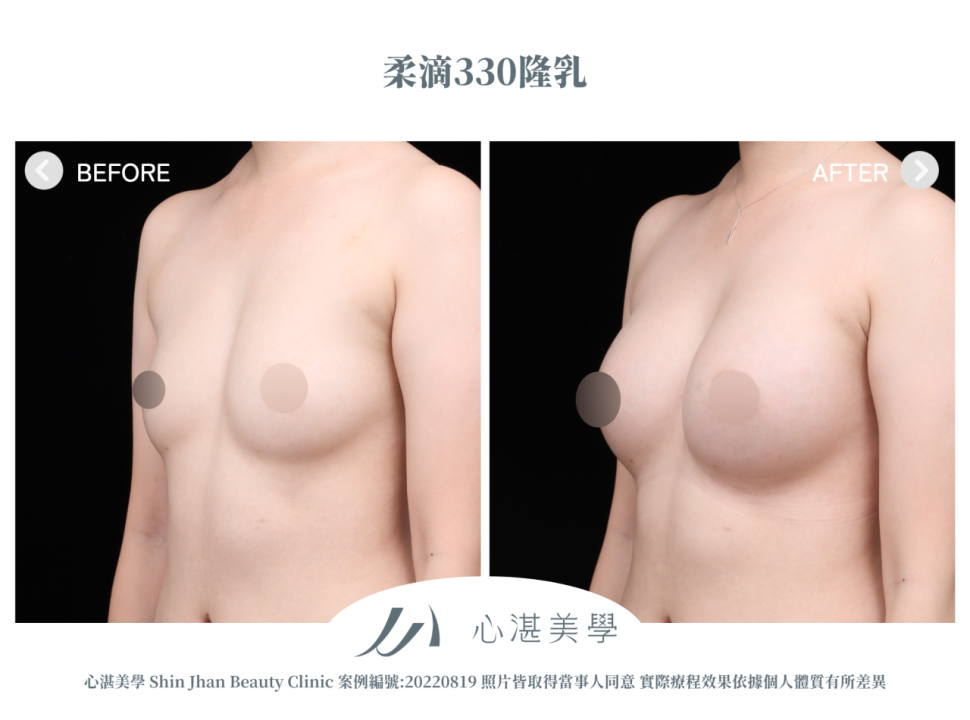 柔滴隆乳 術前術後案例分享