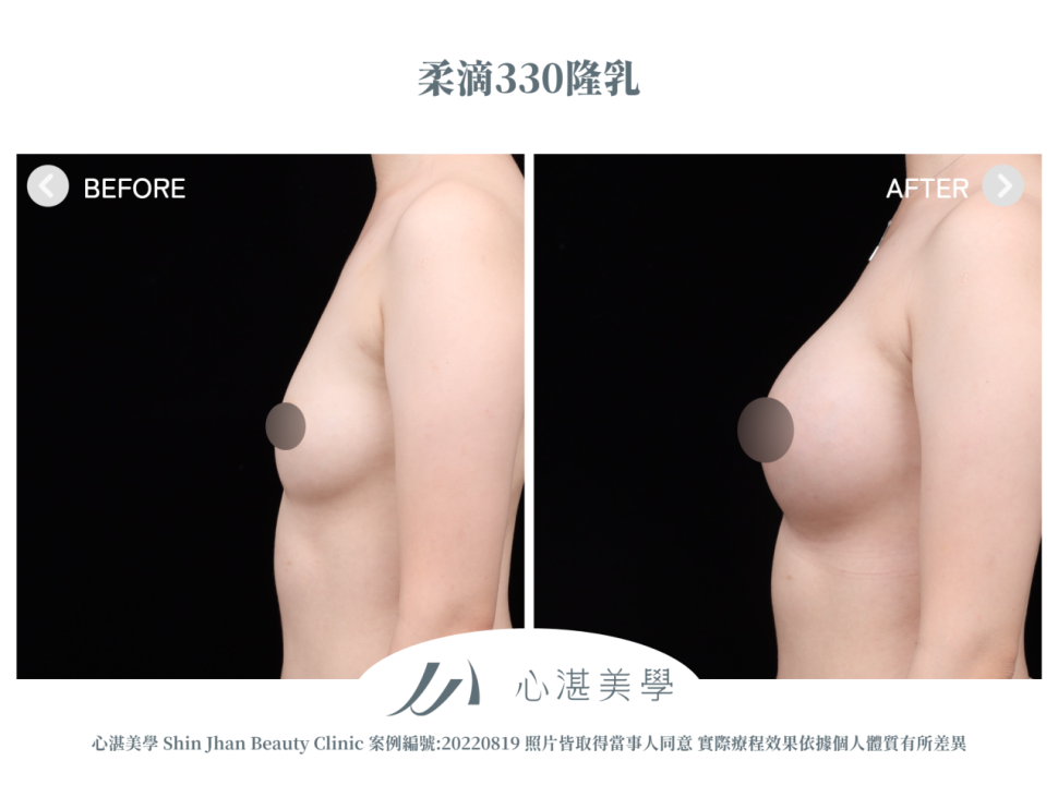柔滴隆乳 術前術後案例分享