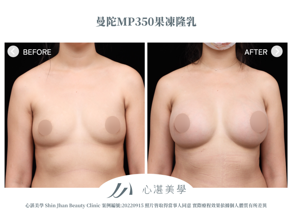 曼陀果凍矽膠隆乳 術前術後案例分享