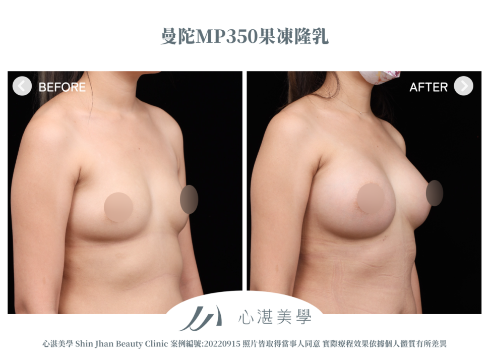 曼陀果凍矽膠隆乳 術前術後案例分享