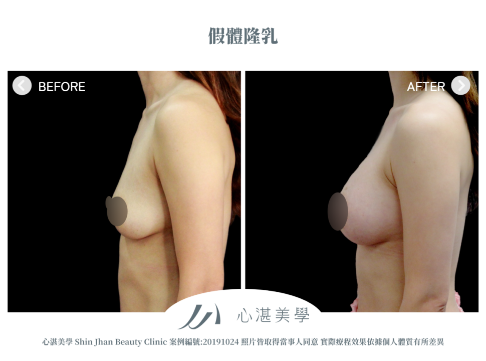 曼陀果凍矽膠隆乳 術前術後案例分享