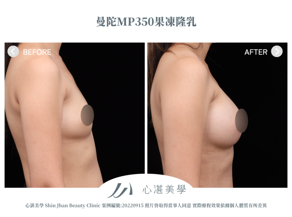 曼陀果凍矽膠隆乳 術前術後案例分享