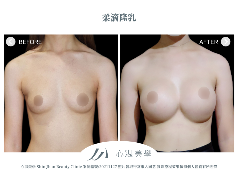 柔滴隆乳 術前術後案例分享