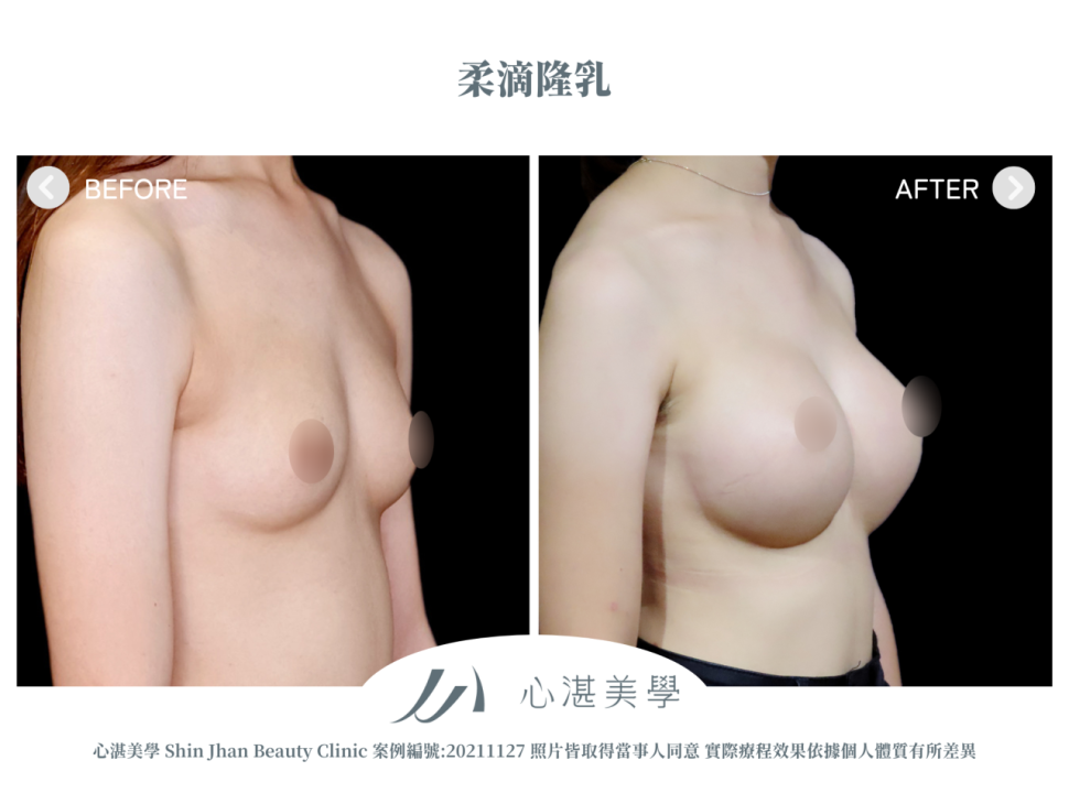 柔滴隆乳 術前術後案例分享