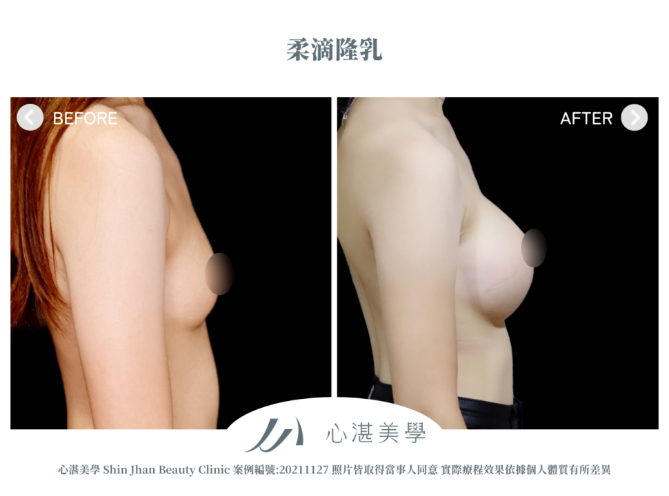 柔滴隆乳 術前術後案例分享