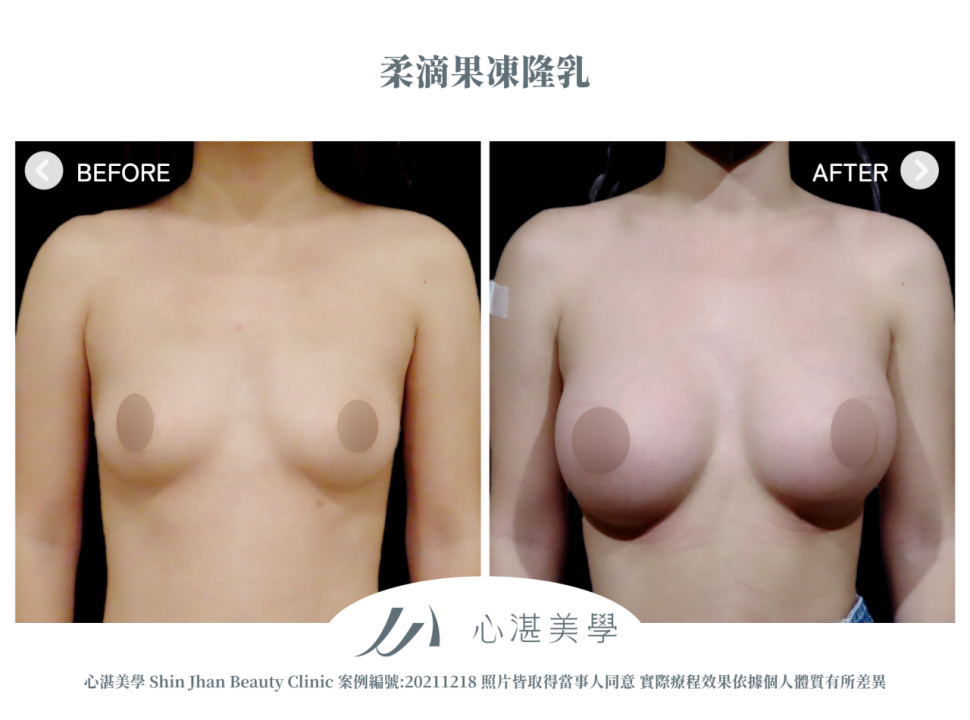 柔滴隆乳 術前術後案例分享