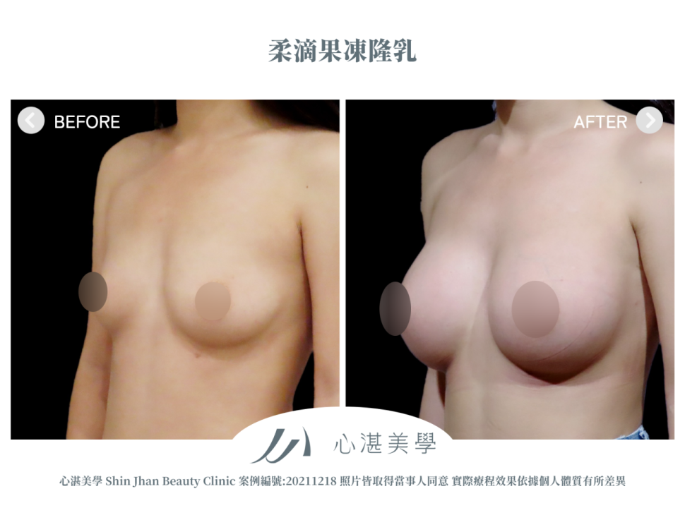 柔滴隆乳 術前術後案例分享