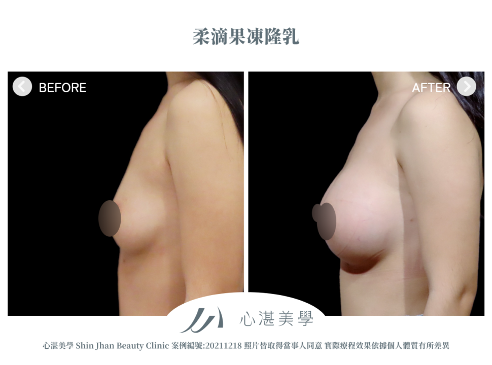 柔滴隆乳 術前術後案例分享
