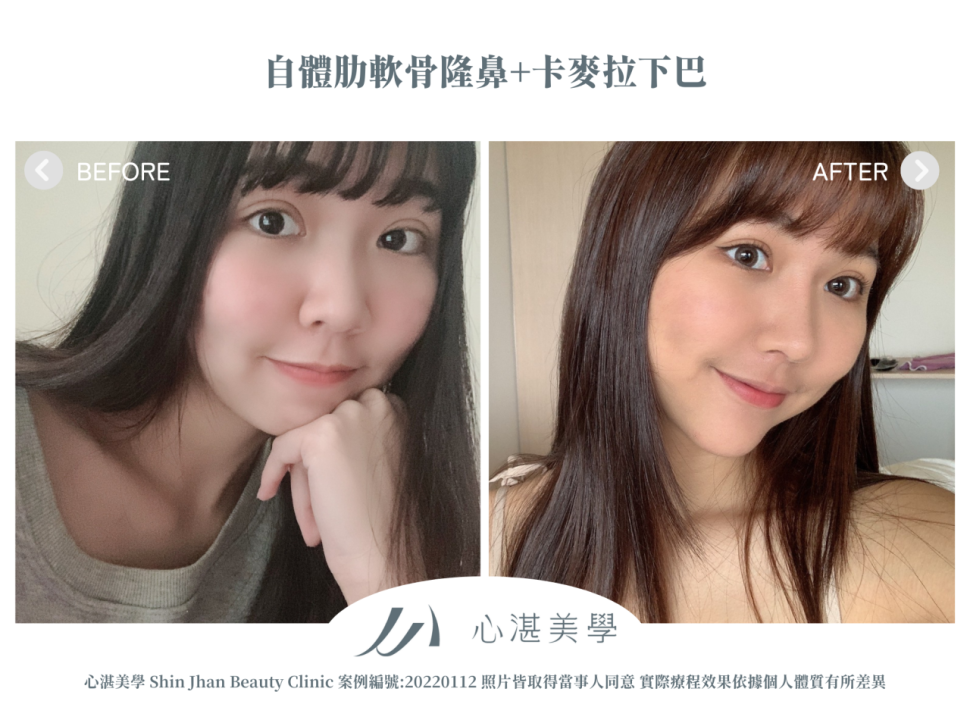 自體肋軟骨隆鼻+卡麥拉下巴 術前術後案例分享