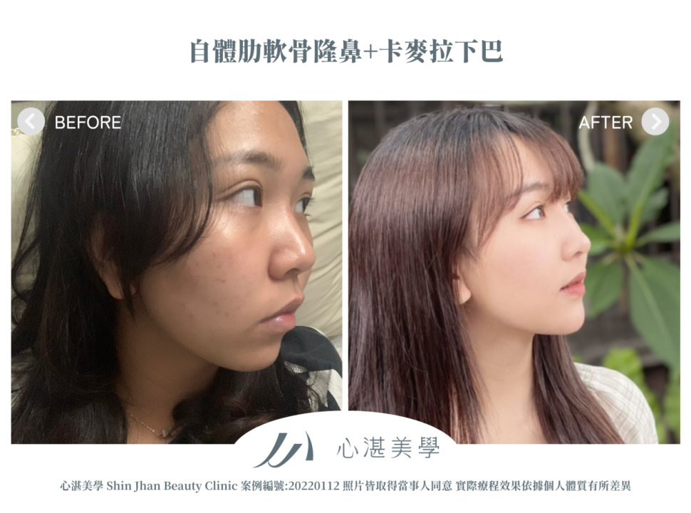 自體肋軟骨隆鼻+卡麥拉下巴 術前術後案例分享