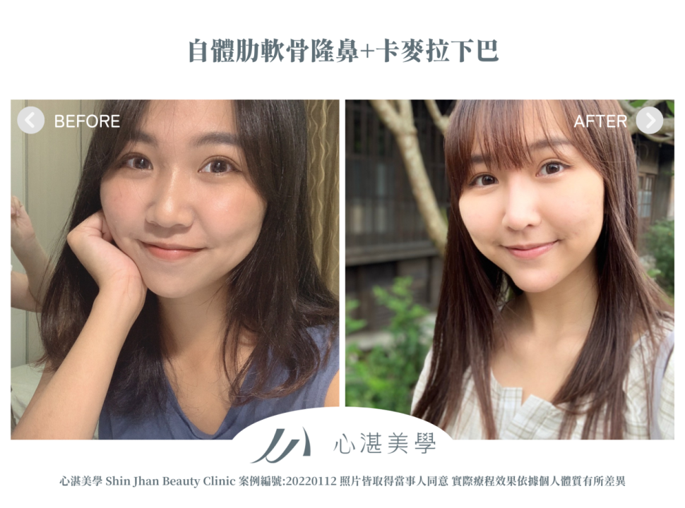 自體肋軟骨隆鼻+卡麥拉下巴 術前術後案例分享