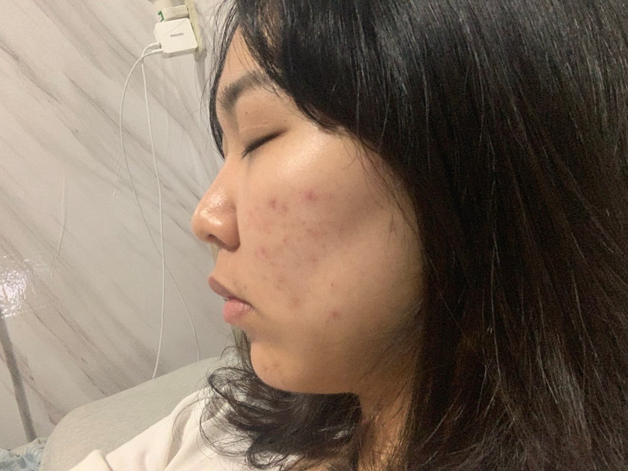 鼻子精緻了，人也跟著精緻！耳軟骨隆鼻＋墊下巴輪廓一次升級。