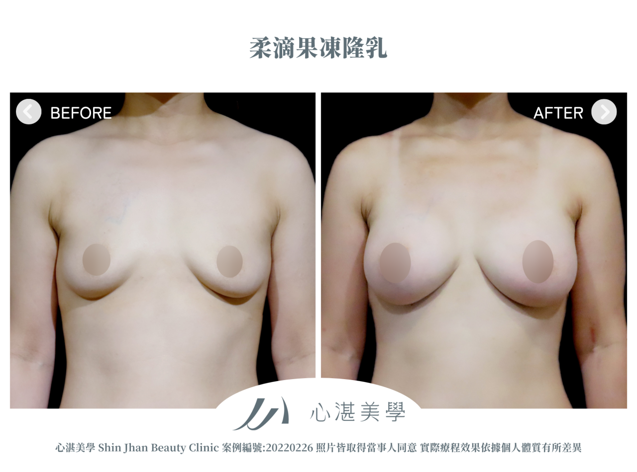 產後胸部萎縮的困擾，柔滴隆乳幫我解決下垂平胸問題