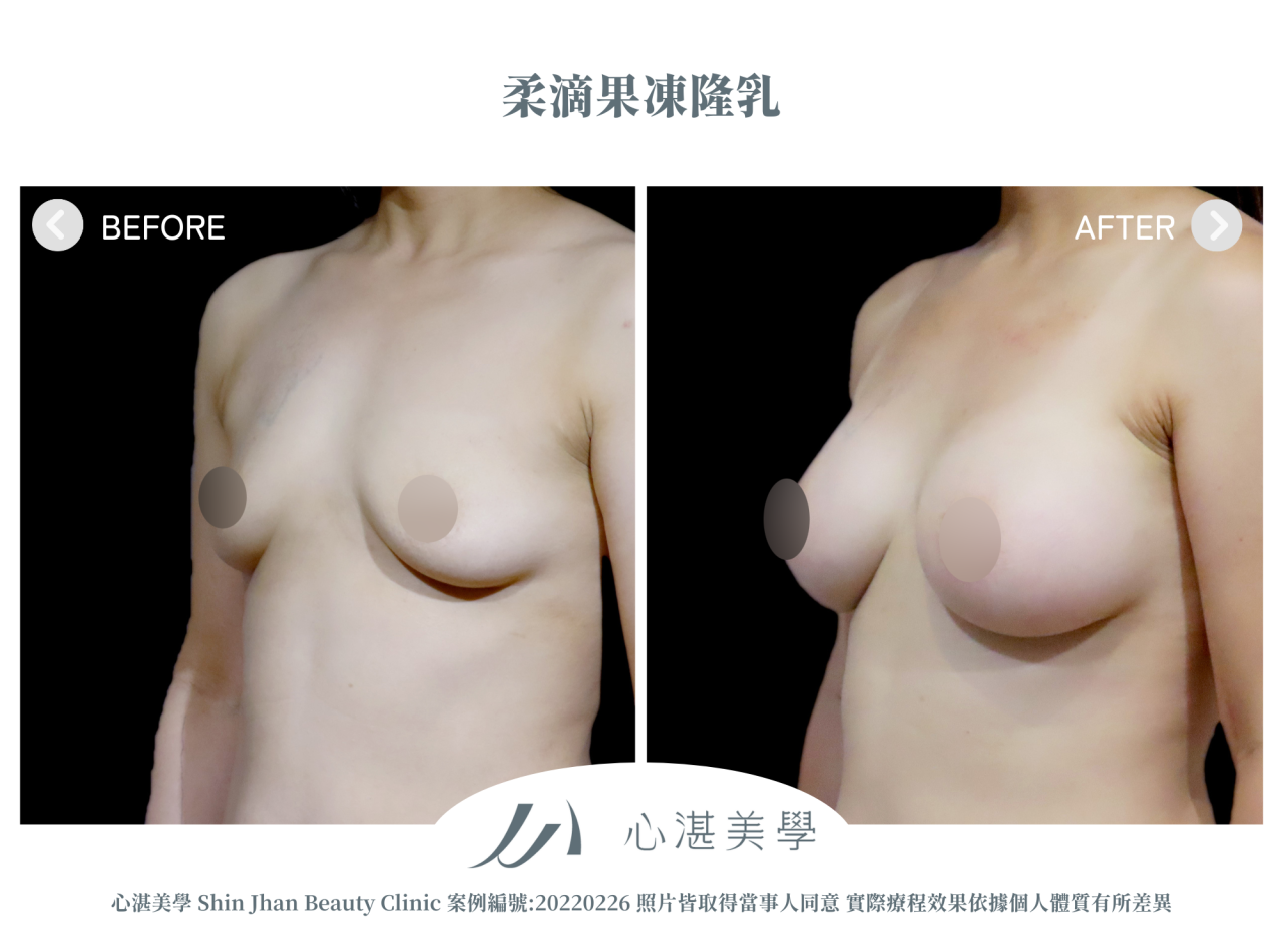 產後胸部萎縮的困擾，柔滴隆乳幫我解決下垂平胸問題
