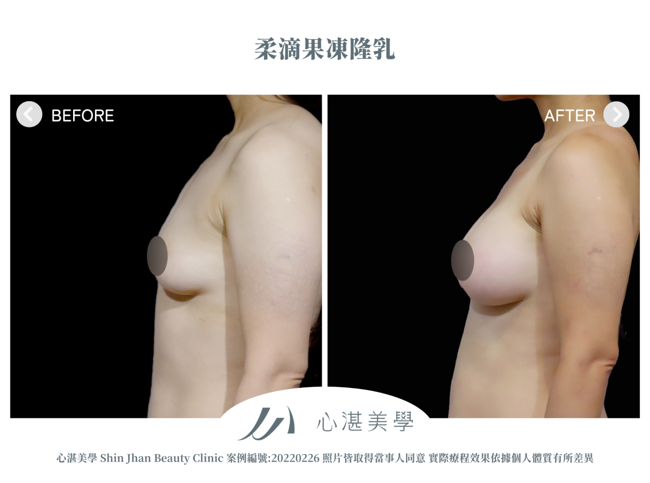 產後胸部萎縮的困擾，柔滴隆乳幫我解決下垂平胸問題
