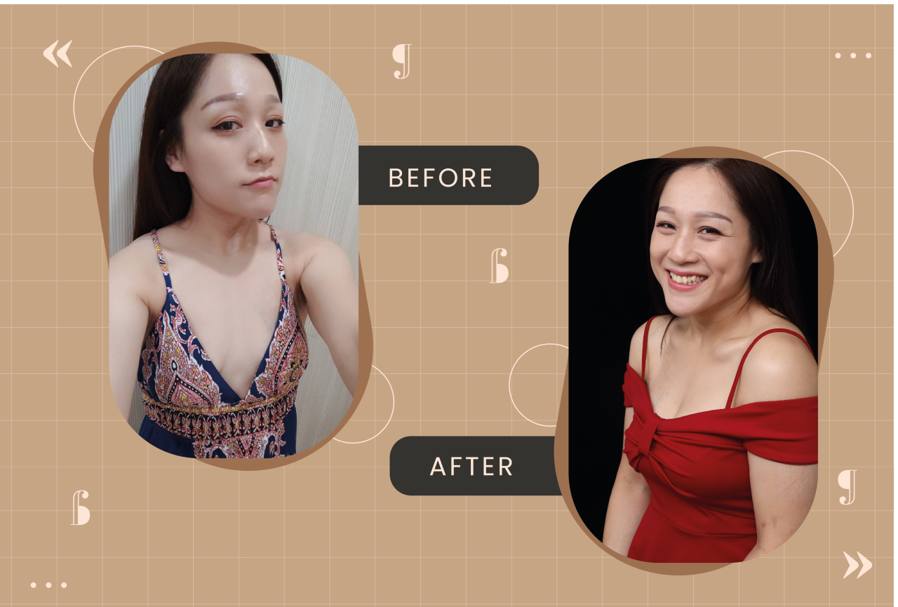 產後胸部萎縮的困擾，柔滴隆乳幫我解決下垂平胸問題