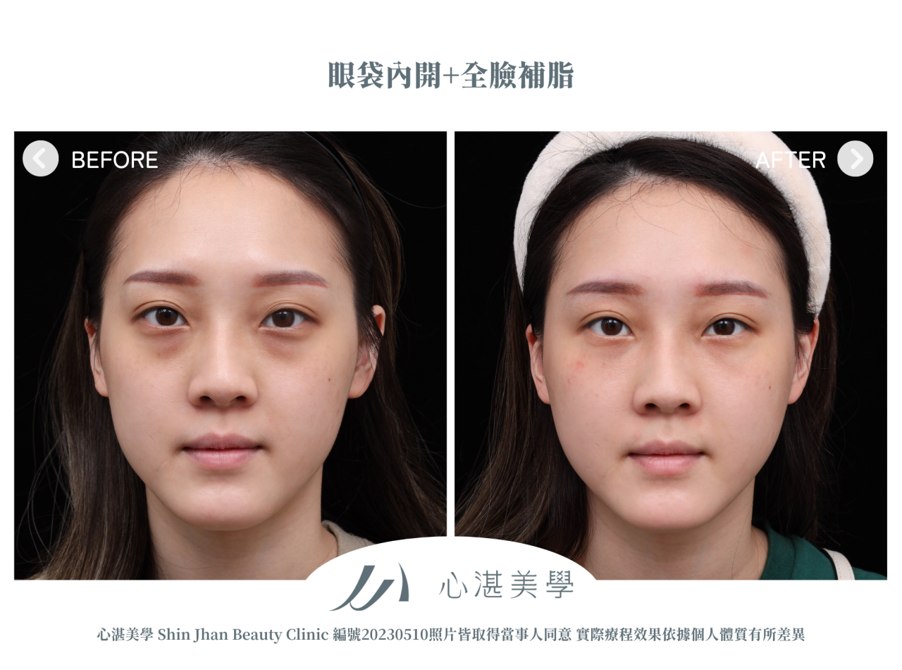 眼袋、淚溝及法令紋顯老，結構式眼袋與補脂是重拾好氣色的秘訣！