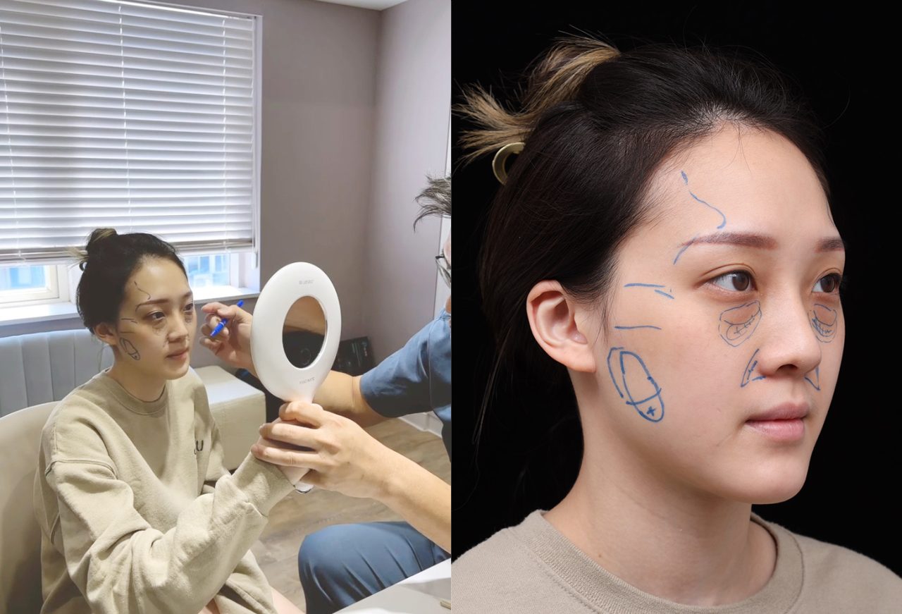 眼袋、淚溝及法令紋顯老，結構式眼袋與補脂是重拾好氣色的秘訣！