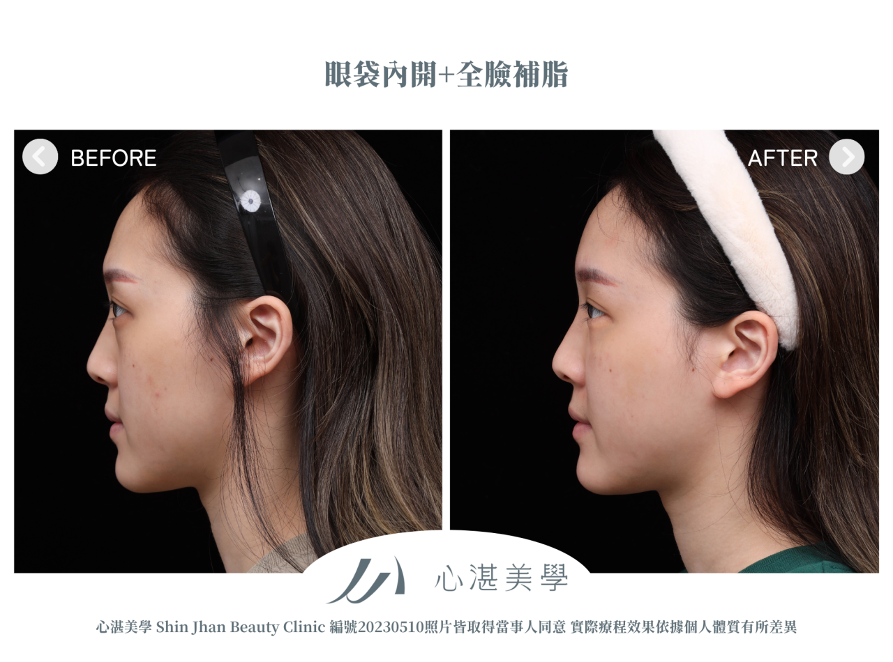 眼袋、淚溝及法令紋顯老，結構式眼袋與補脂是重拾好氣色的秘訣！