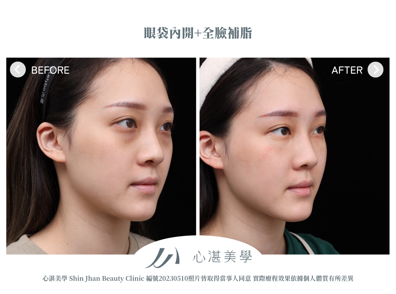 眼袋、淚溝及法令紋顯老，結構式眼袋與補脂是重拾好氣色的秘訣！