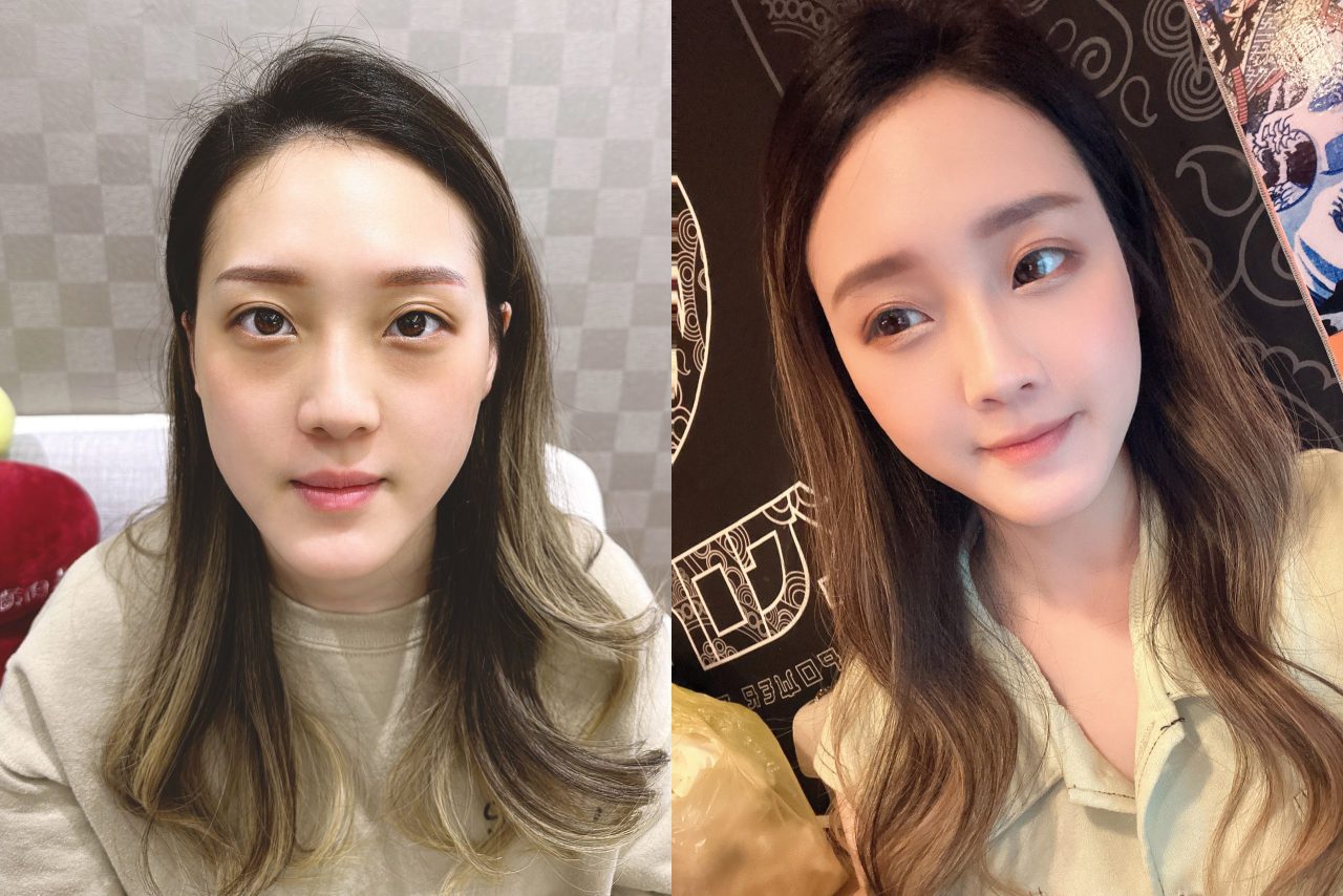 眼袋、淚溝及法令紋顯老，結構式眼袋與補脂是重拾好氣色的秘訣！