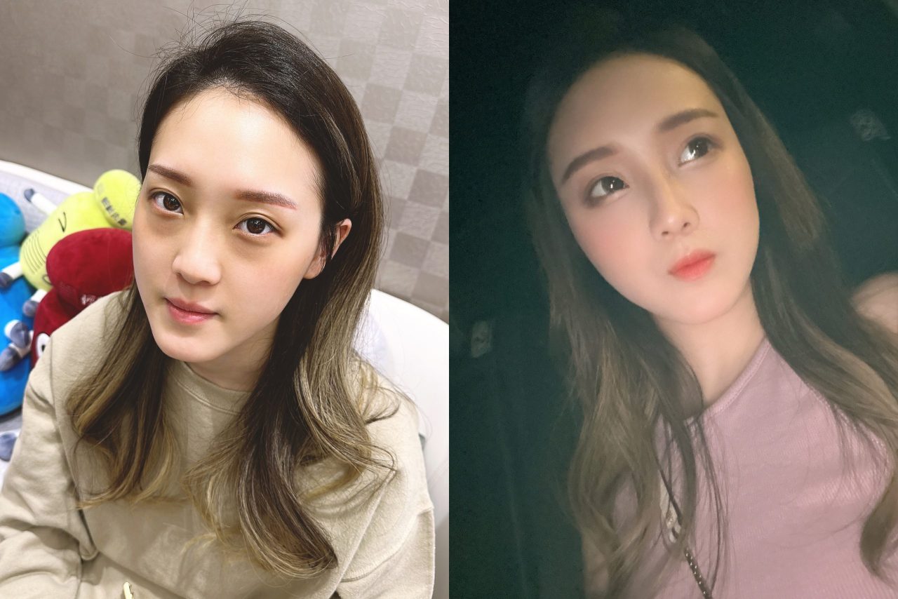 眼袋、淚溝及法令紋顯老，結構式眼袋與補脂是重拾好氣色的秘訣！