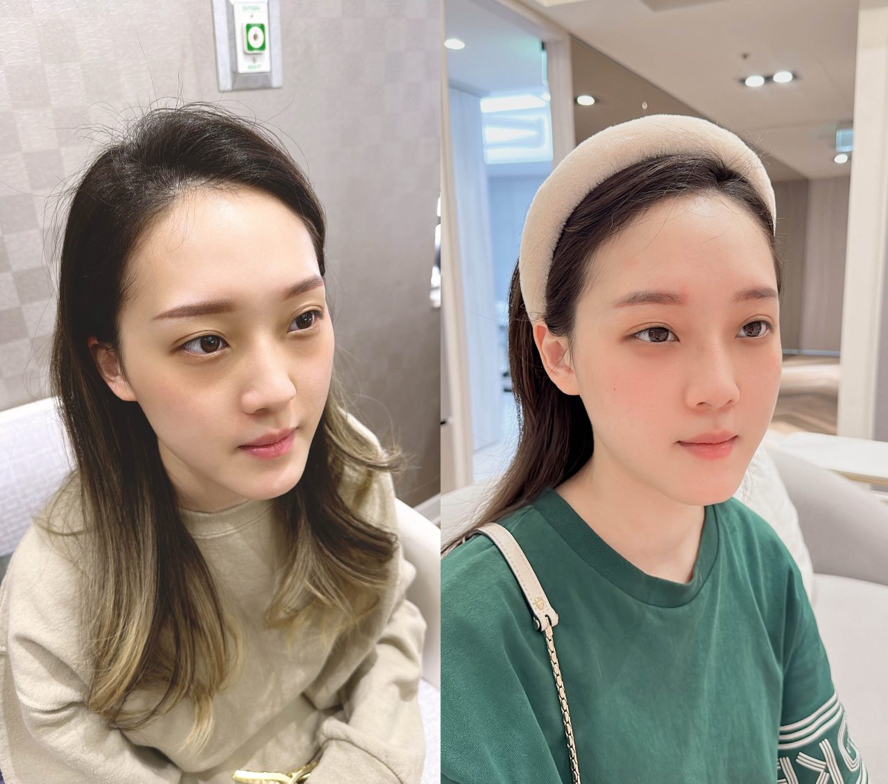 眼袋、淚溝及法令紋顯老，結構式眼袋與補脂是重拾好氣色的秘訣！