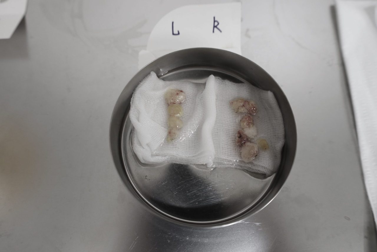 眼袋、淚溝及法令紋顯老，結構式眼袋與補脂是重拾好氣色的秘訣！