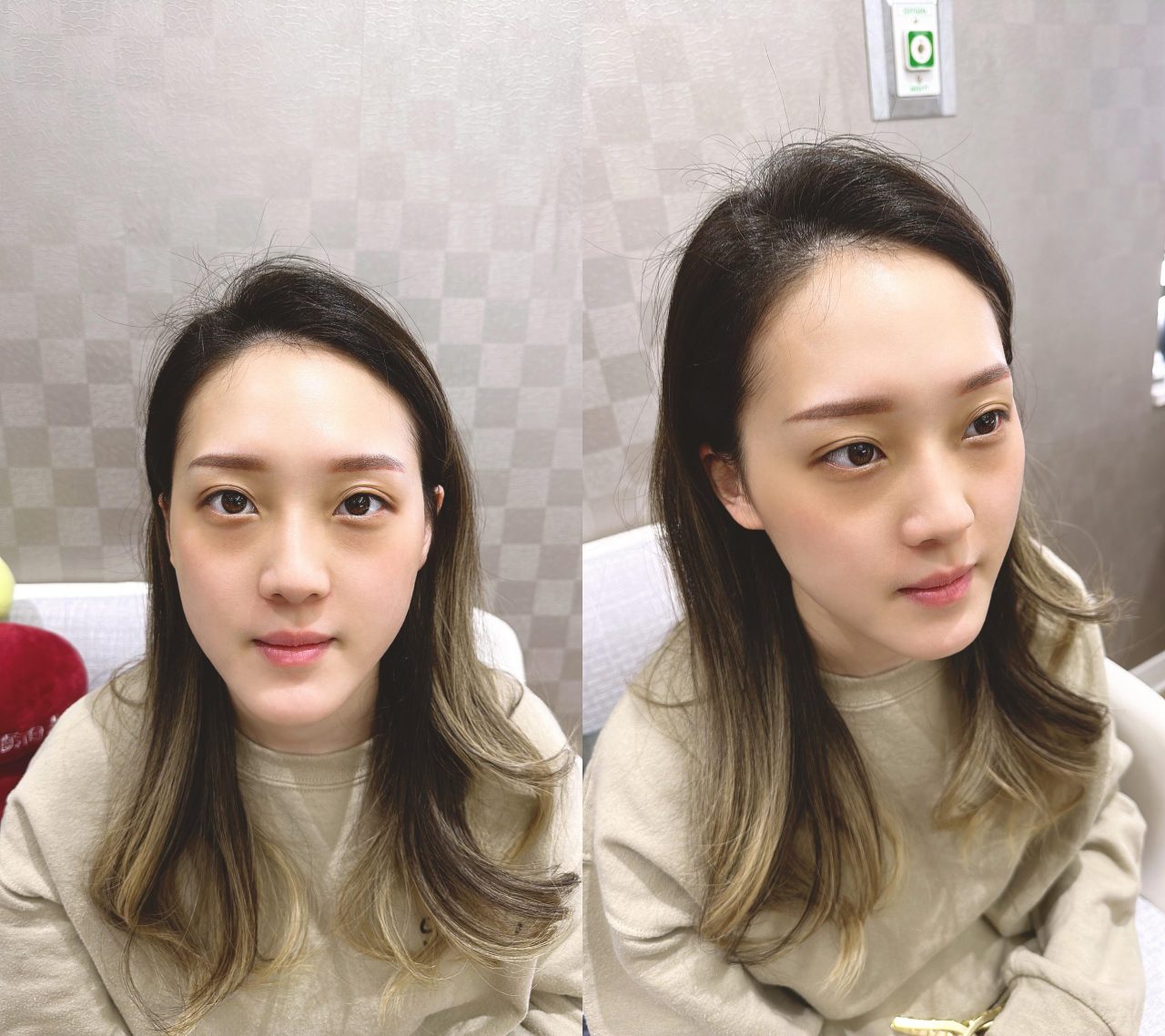 眼袋、淚溝及法令紋顯老，結構式眼袋與補脂是重拾好氣色的秘訣！