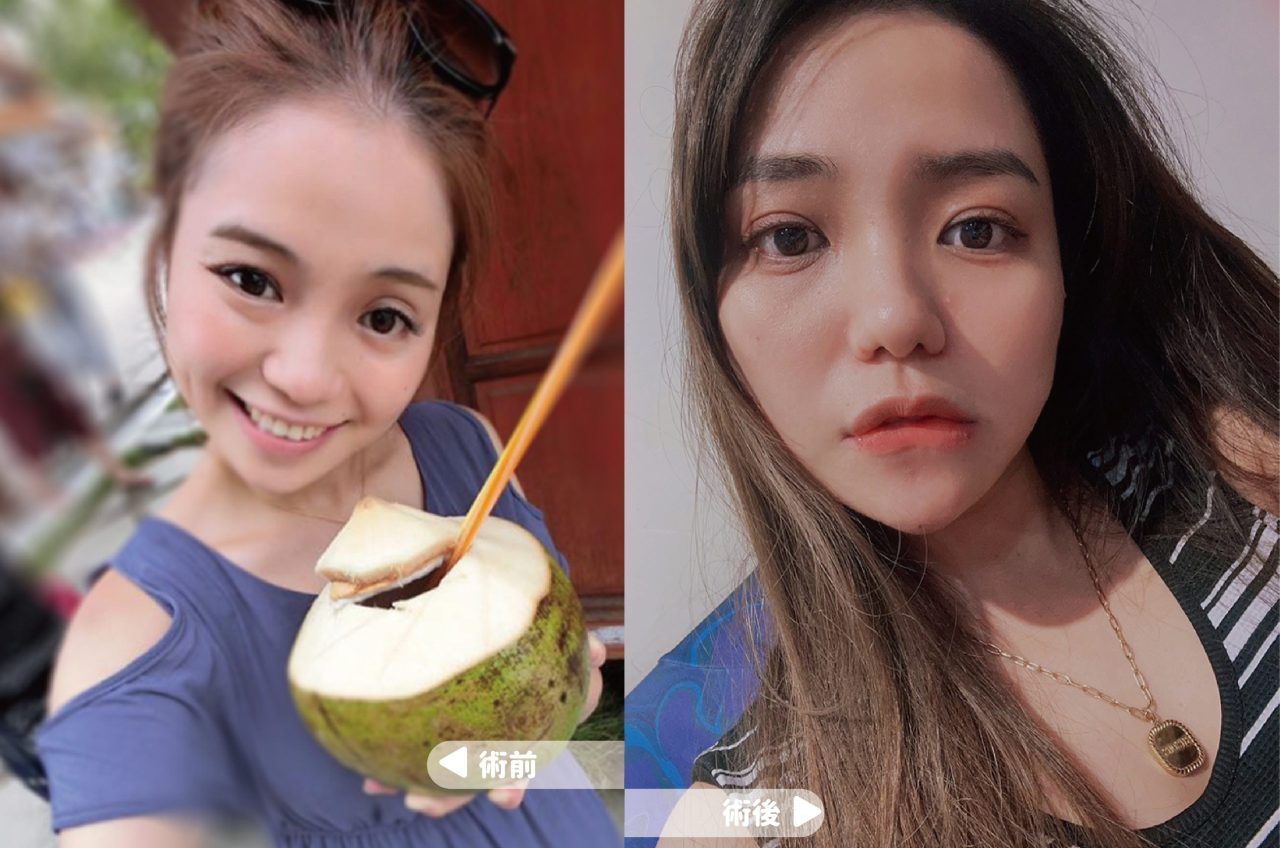 大小眼原來是因為眼窩凹陷！改善大小眼從此不再被說沒睡飽