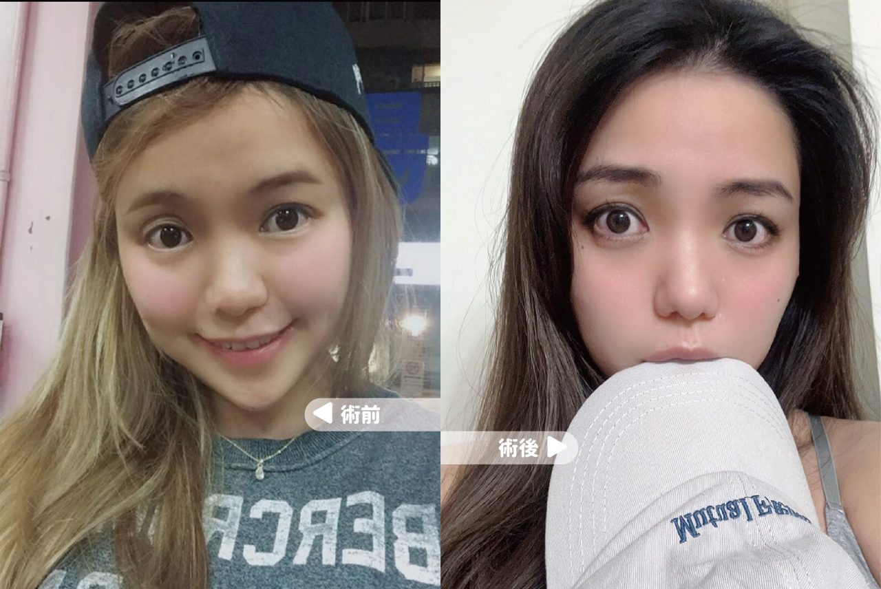大小眼原來是因為眼窩凹陷！改善大小眼從此不再被說沒睡飽