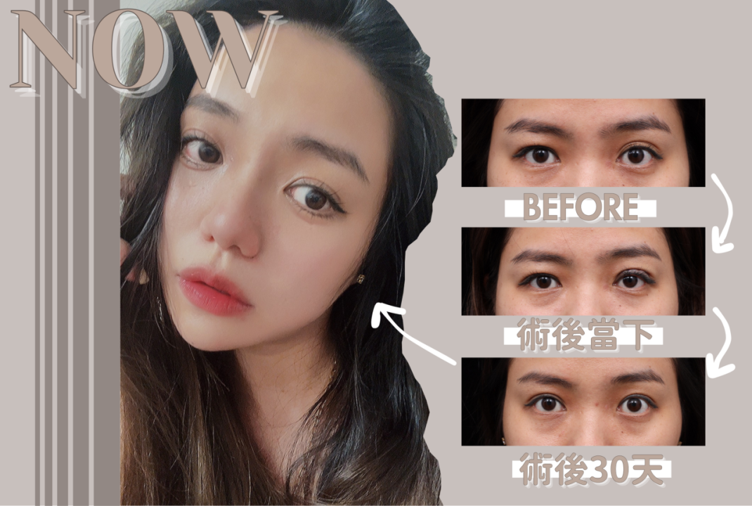 大小眼原來是因為眼窩凹陷！改善大小眼從此不再被說沒睡飽