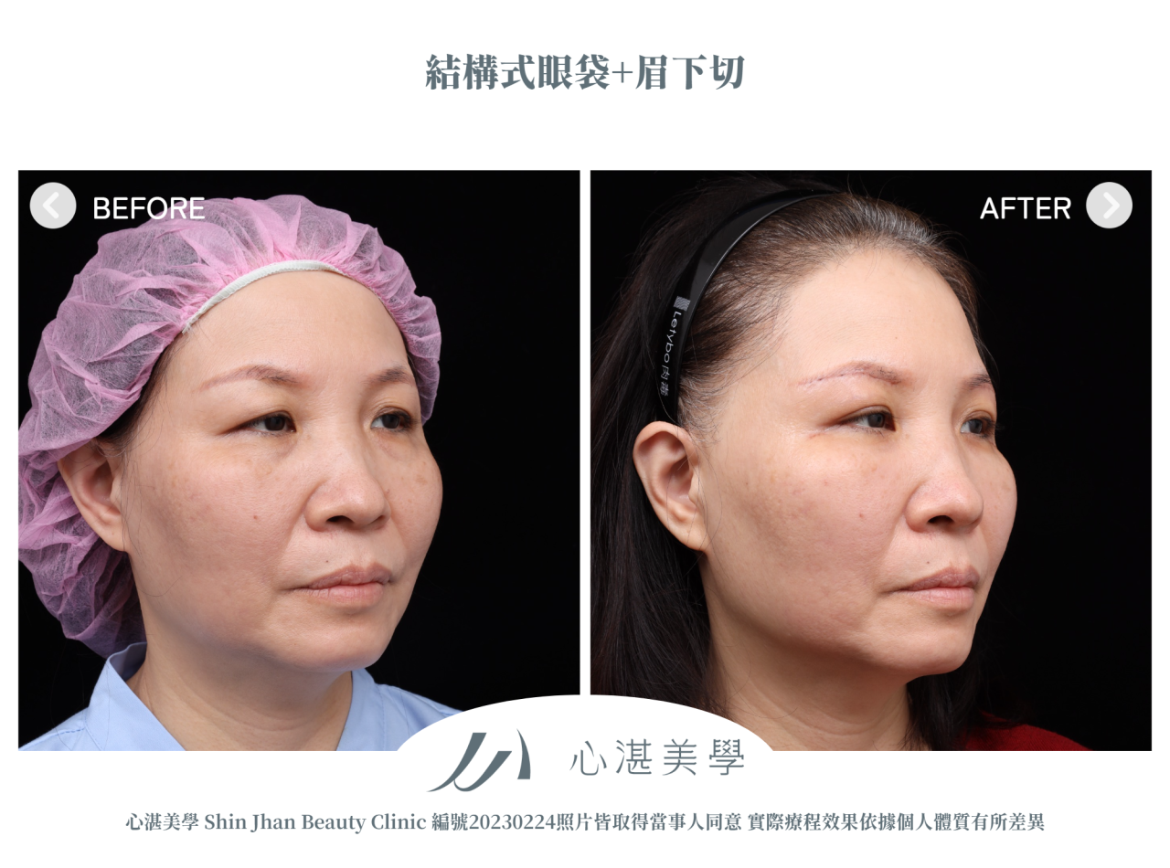 結構式眼袋+微創提眉手術(眉下切)術前術後案例分享