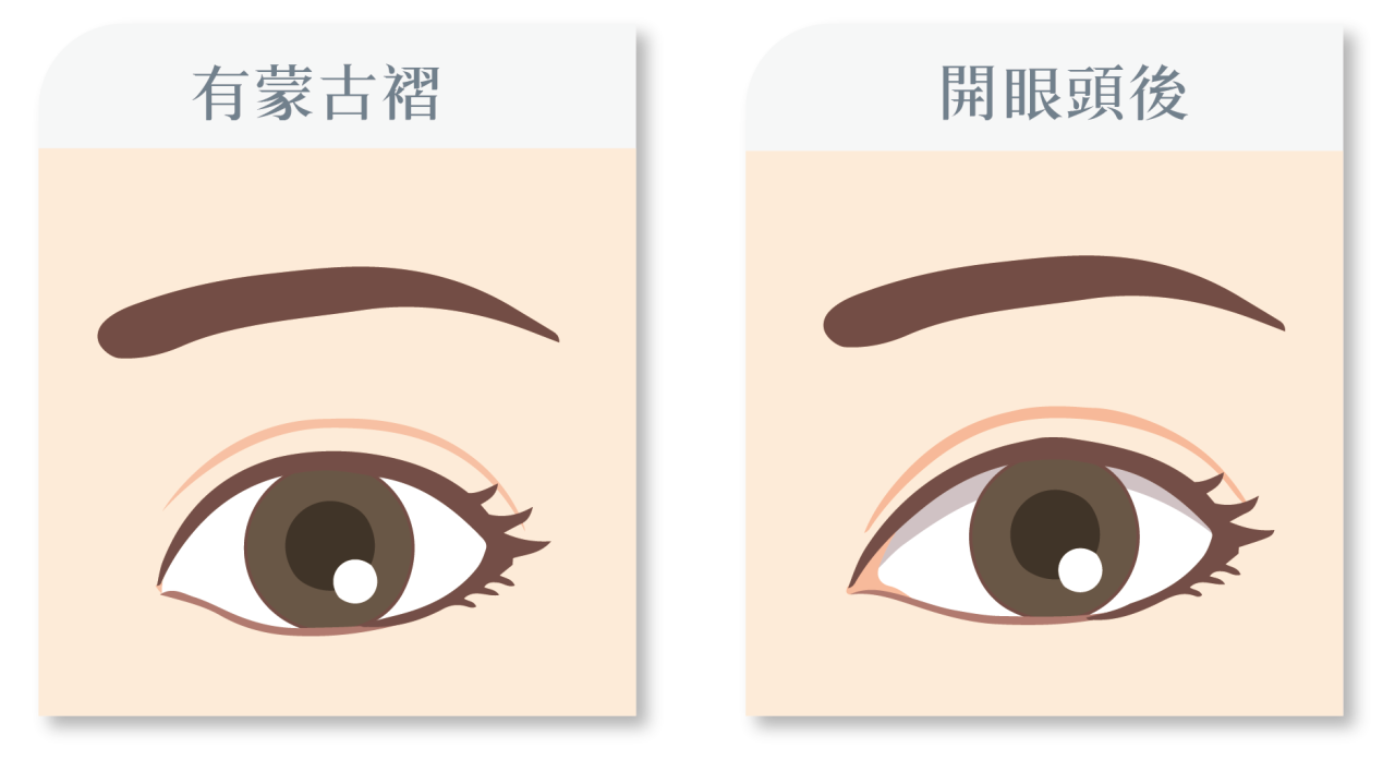 開眼頭手術是什麼？蒙古褶vs開眼頭後