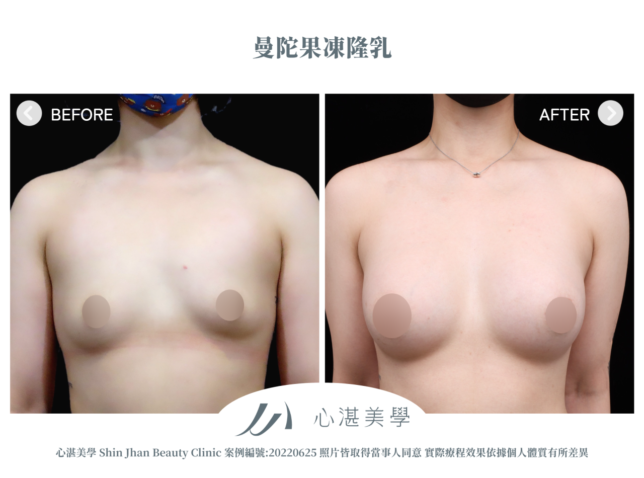 隆乳手術 術前術後案例分享 曼陀果凍矽膠