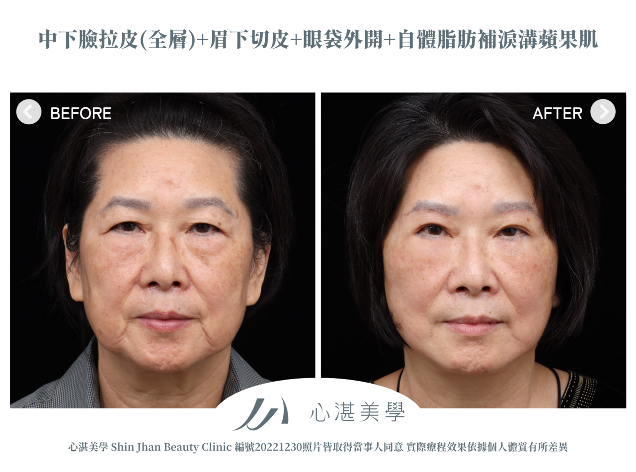 中下臉拉皮+眼袋外開+微創提眉手術(眉下切)+脂肪補淚溝術前術後案例分享