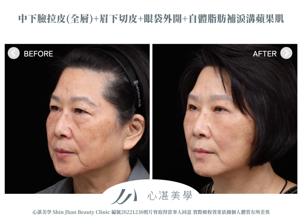 中下臉拉皮+眼袋外開+微創提眉手術(眉下切)+脂肪補淚溝術前術後案例分享